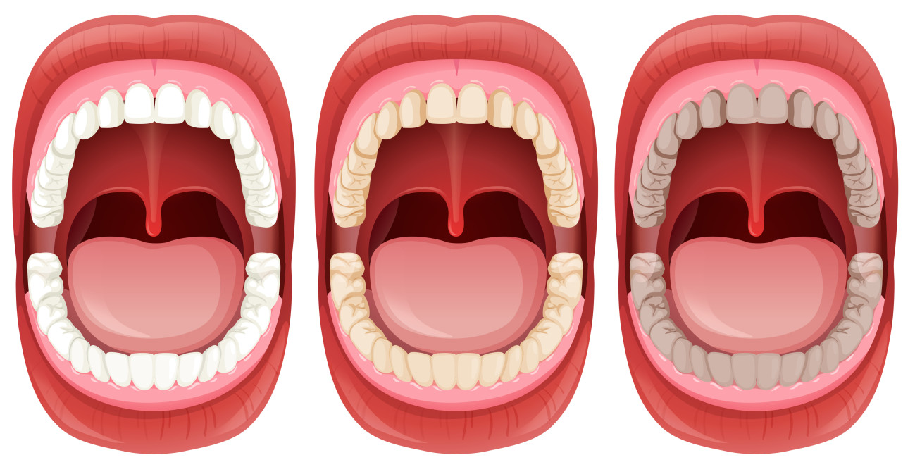 tooth-erosion