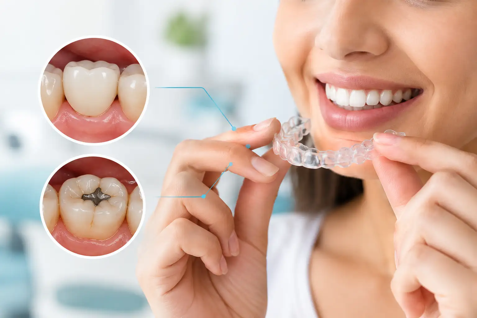 clear-aligners-with-dental-crowns-and-tooth-fillings