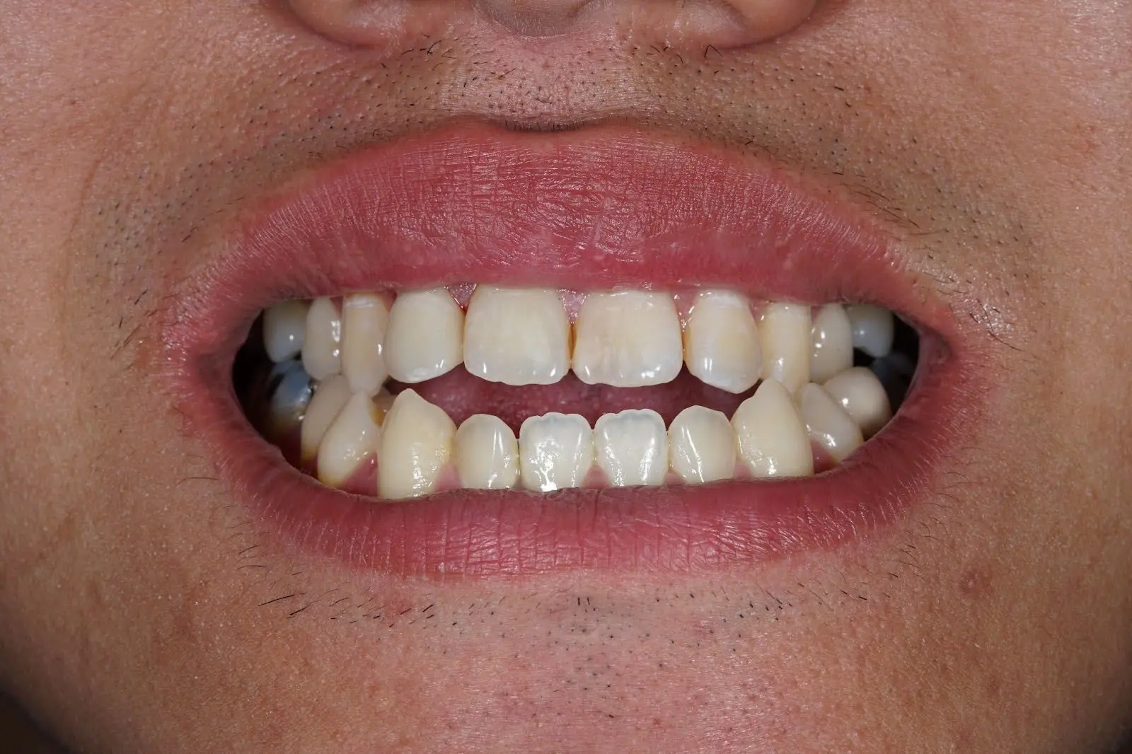 open-bite-types-causes-and-treatment-dentique-cochin