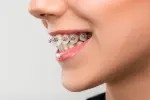 best-type-of-braces