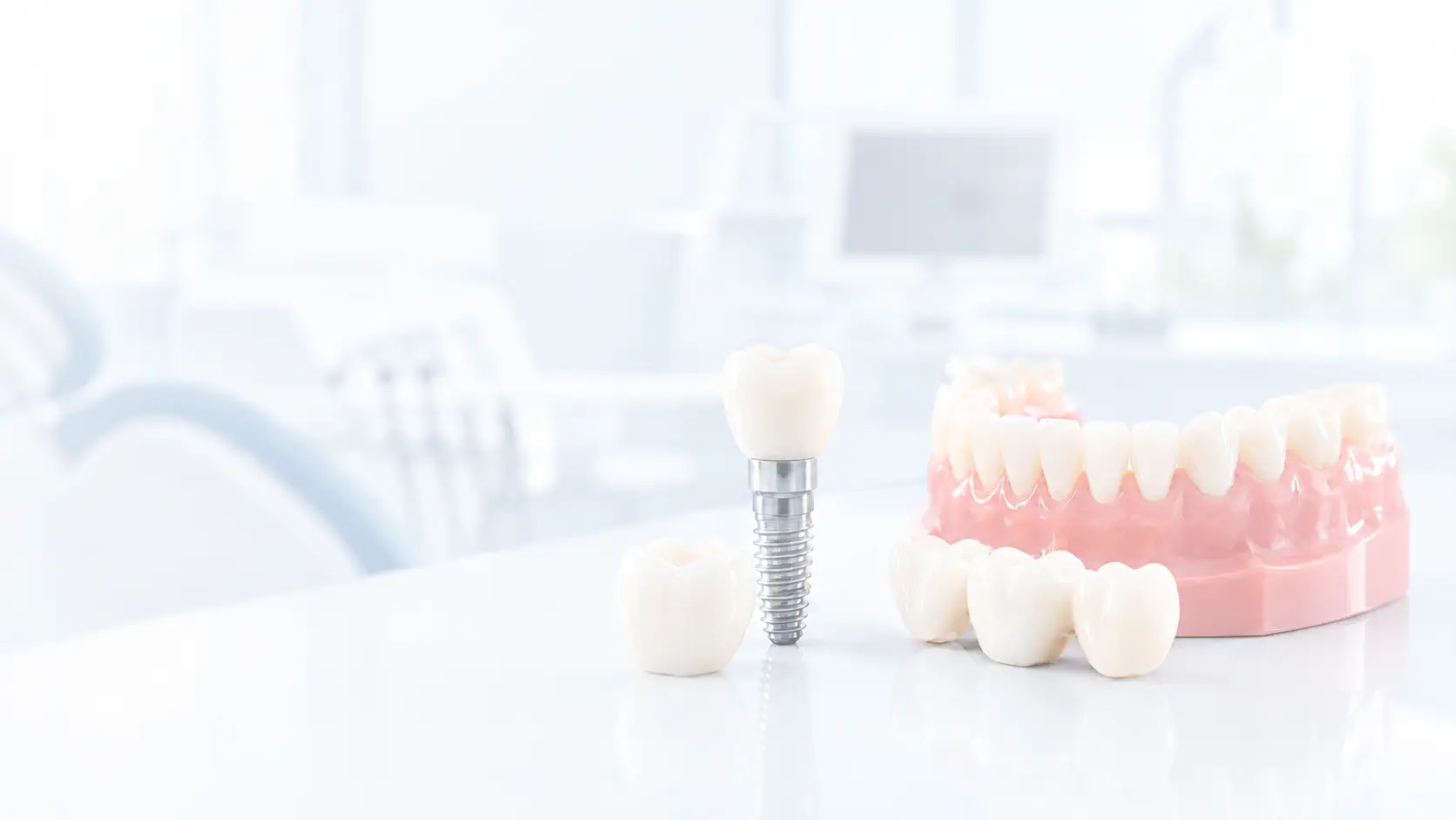 Dental-implant-with-a-ceramic-crown-loose-dental-crowns-and-a-realistic-dental-model-displayed-on-a-glossy-surface-in-a-bright-dental-clinic-with-a-soft-white-overlay